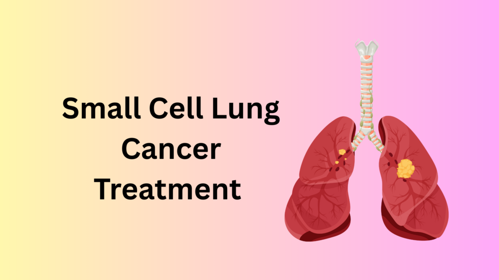 Small Cell Lung Cancer: Early Diagnosis and Advanced Treatment Options Small Cell Lung Cancer Treatment