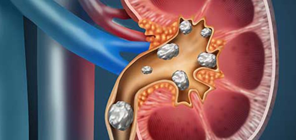 Laser vs PCNL vs RIRS: Which Kidney Stone Surgery Is Best for You? kidney stone disease