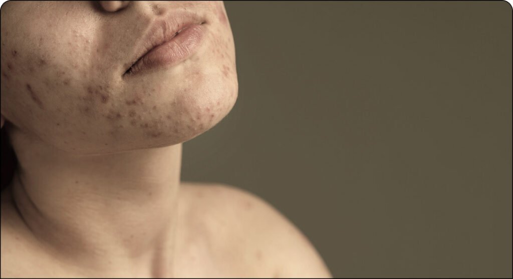 How to Prevent Acne Scars with Early Treatment acne treatment