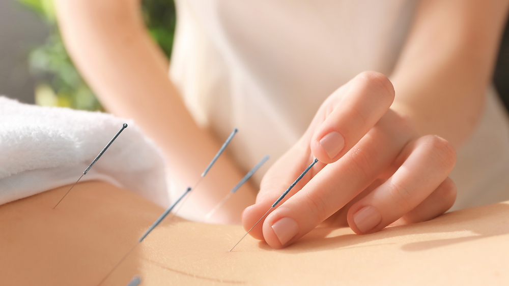 How Effective Is Acupuncture Fertility for IVF