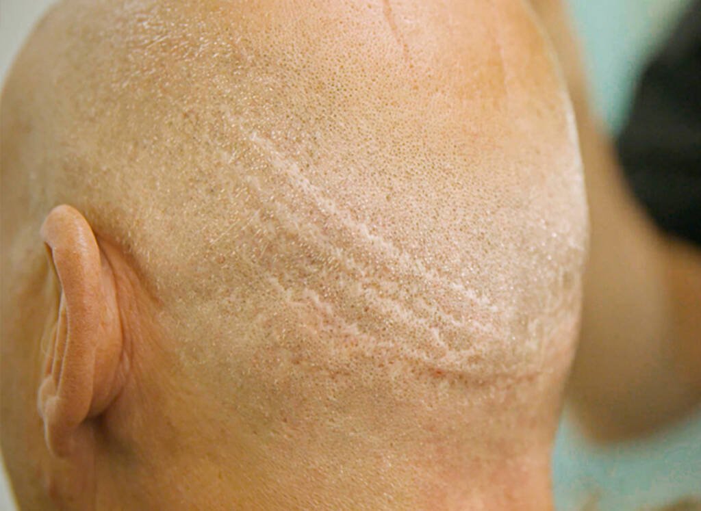 Can A Hair Transplant for a Scar Restore Natural Growth? Can A Hair Transplant for a Scar Restore Natural Growth?
